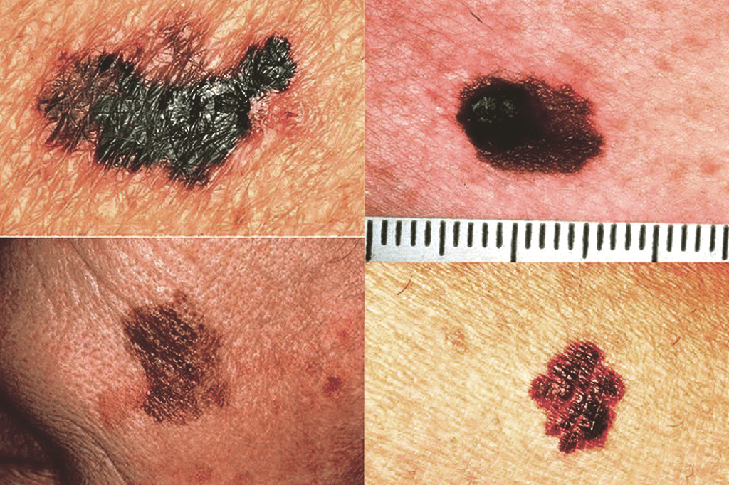 Melanomas