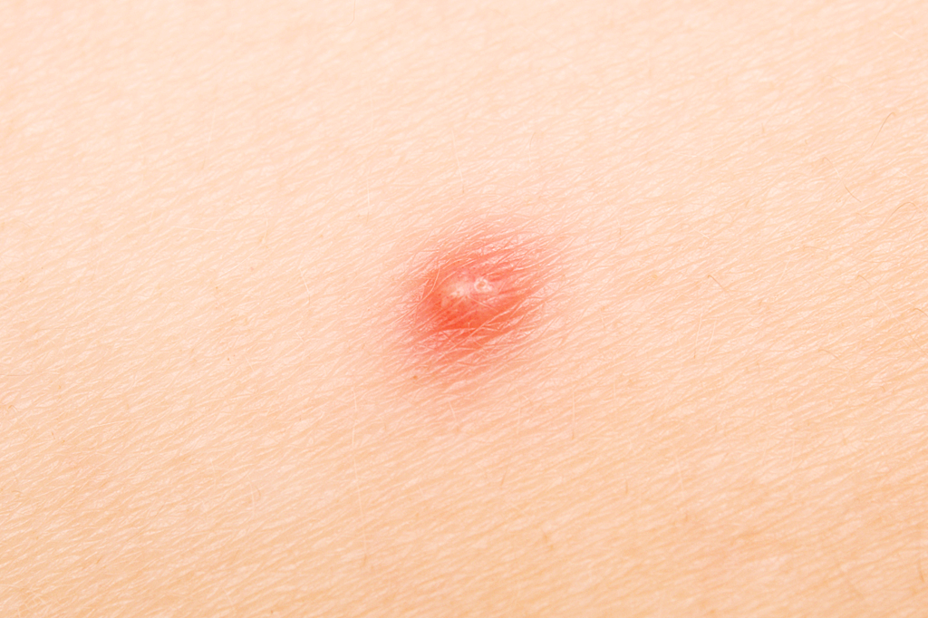 Por que vídeos de espinhas fazem tanto sucesso? A ciência explica