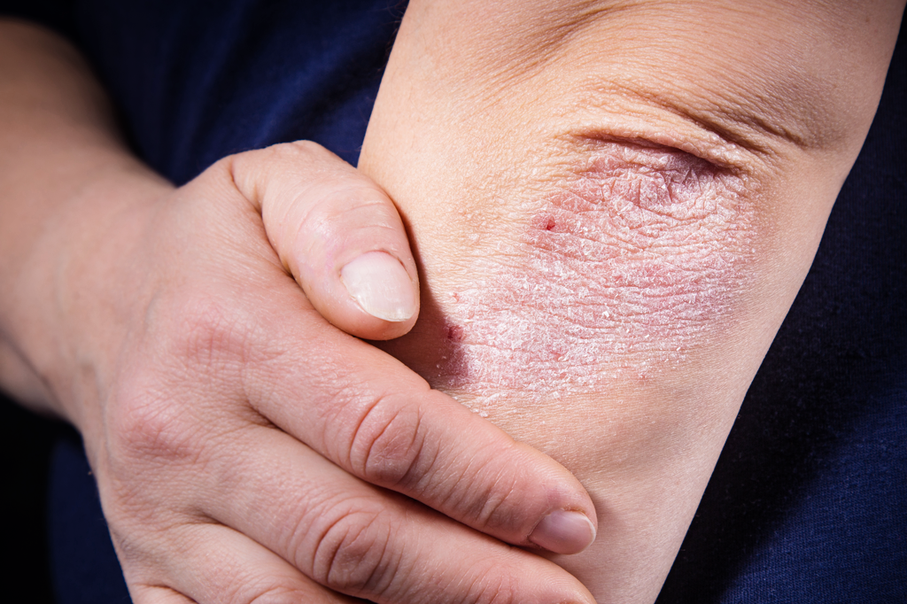 As doenças de pele que mais abalam o bem-estar