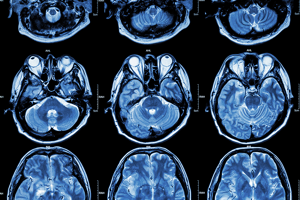 Mulher cega consegue enxergar objetos – desde que eles se movam