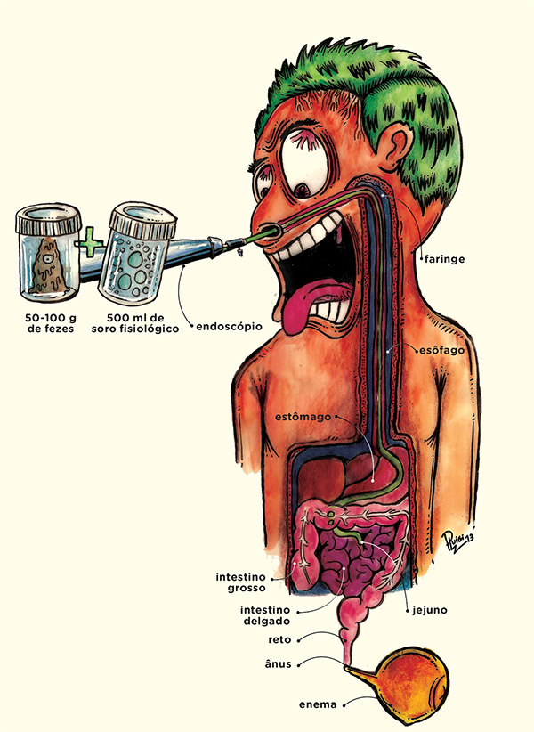 Como é feito o transplante de fezes?