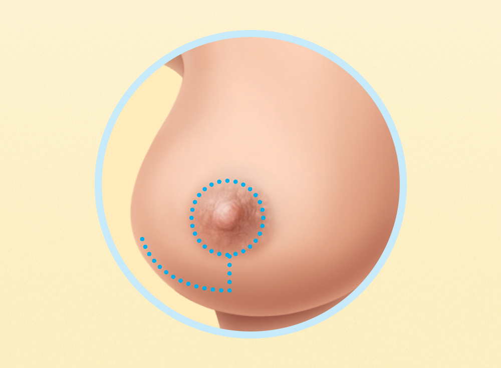 Como se faz uma cirurgia de redução da mama?