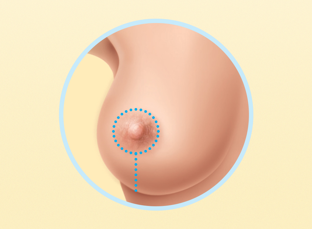 Como se faz uma cirurgia  de redução da mama?