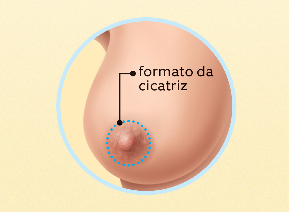 Como se faz uma cirurgia de redução da mama?