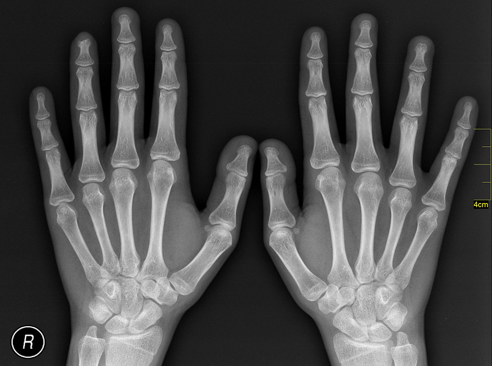 Qual é a diferença entre raios X e escaneamento de corpo?