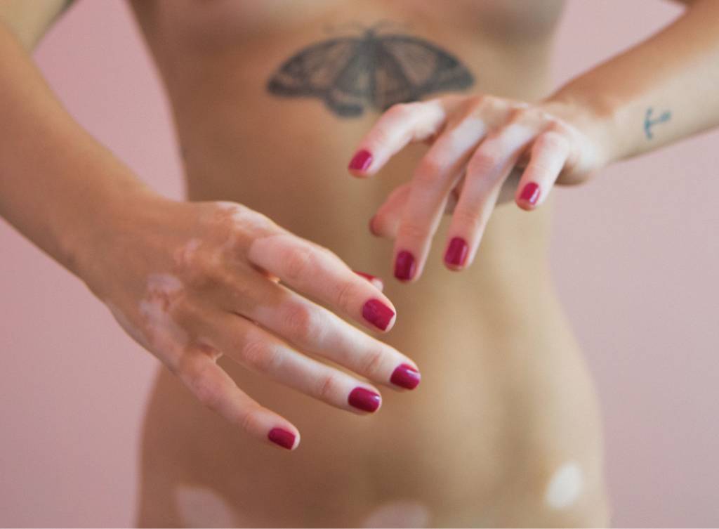 O que é o vitiligo? Como ele surge?