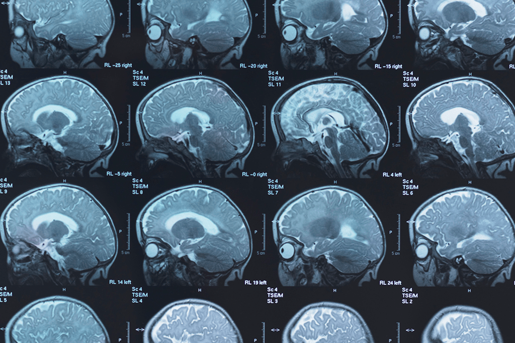 Cérebro das mulheres é, em média, 4 anos mais jovem que o dos homens