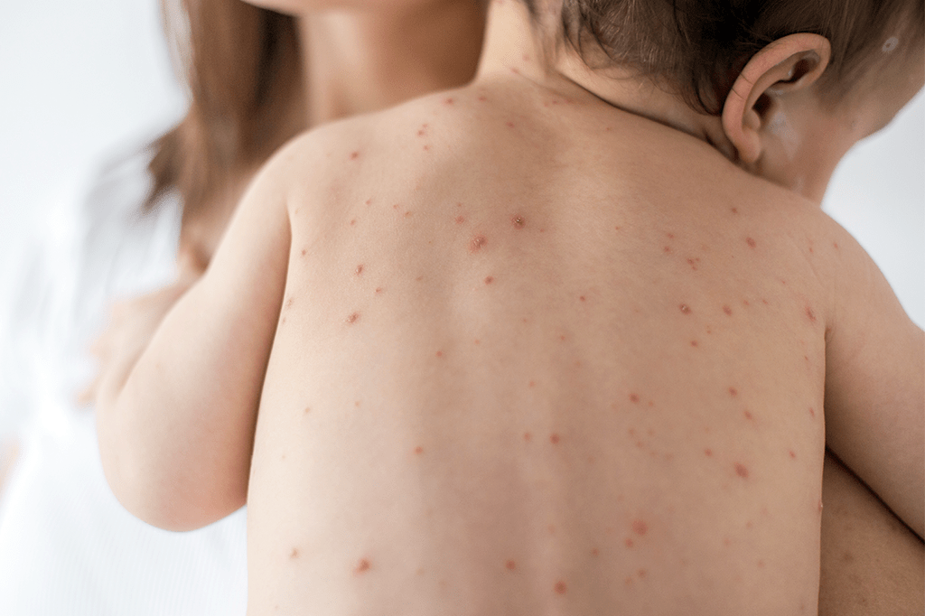 Sarampo é tão contagioso quanto gripe – e a vacina é a única forma de prevenção