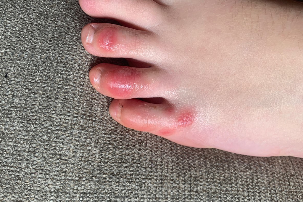 O que são os “dedos de Covid”, possível sintoma do coronavírus