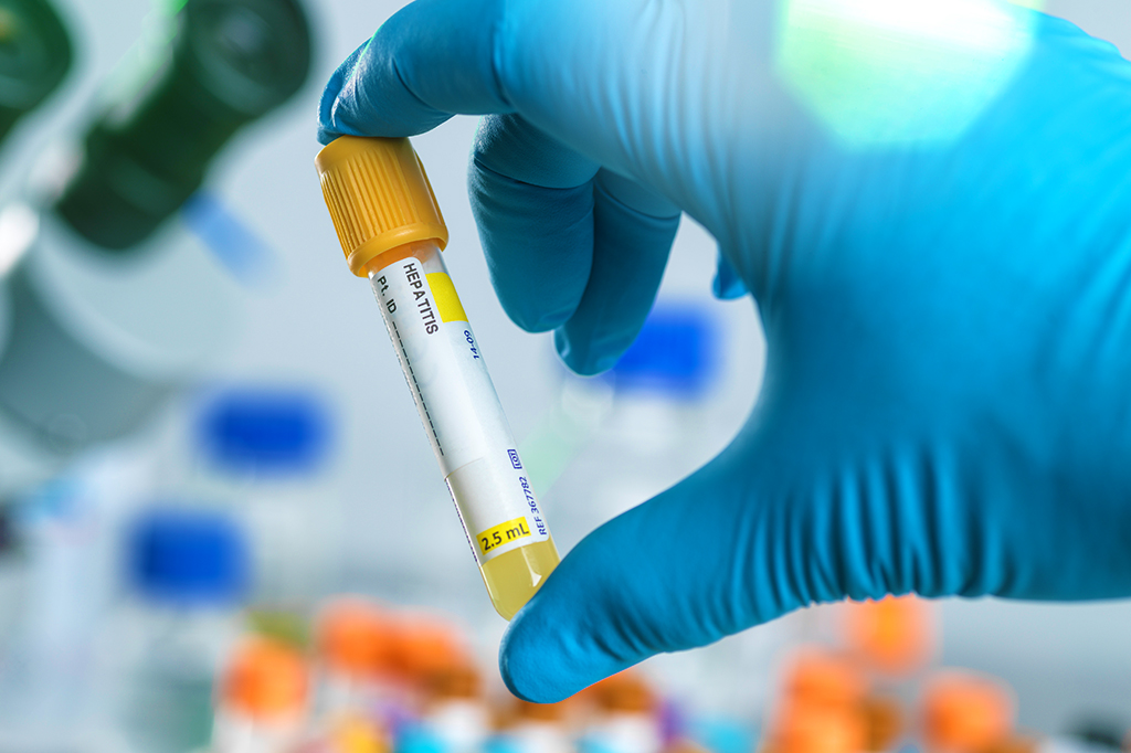 OMS confirma 169 casos de hepatite infantil de causa desconhecida