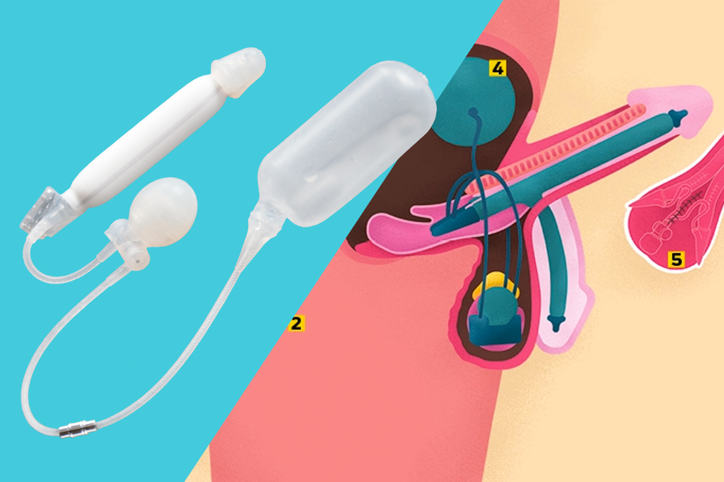 Como funciona um implante peniano?