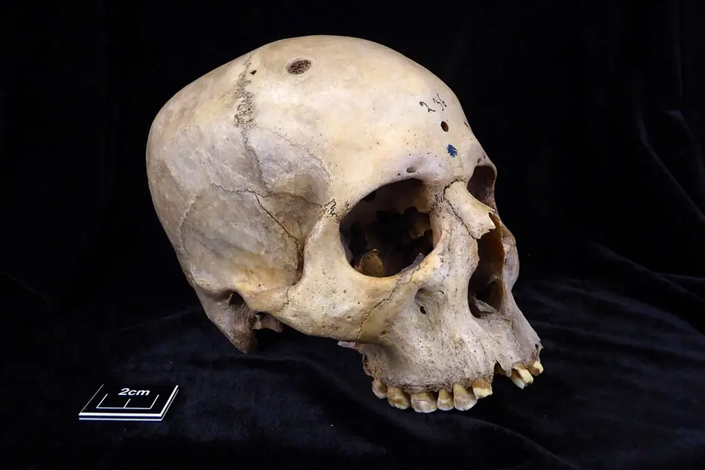 Crânio de um homem com idade entre 30 e 35 que apresenta marcas de corte nas bordas do crânio, cercando dezenas de lesões resultantes de câncer cerebral com metástase.