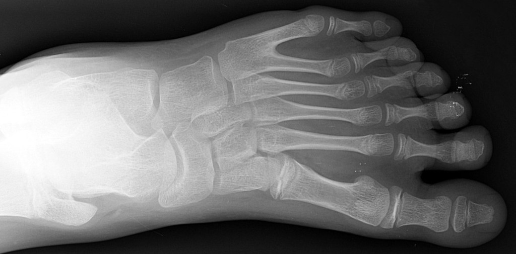 Raio X de pessoa com polidactilia, mostrando dois dedos do pé.