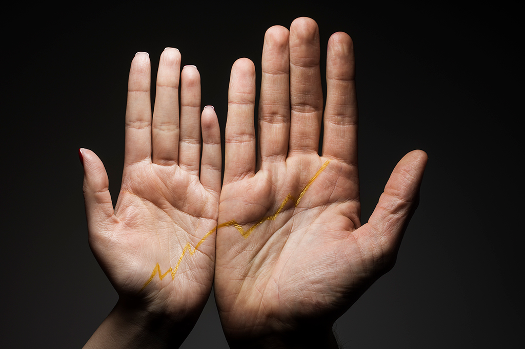 O que é a acromegalia, doença rara que faz a pessoa crescer demais