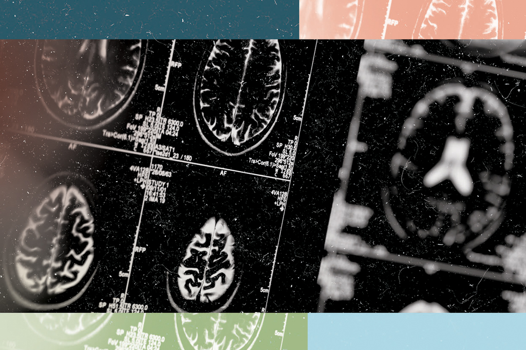 3 notícias sobre: demência