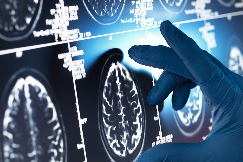 Lítio pode ser peça-chave no tratamento do Alzheimer, sugere estudo de Harvard